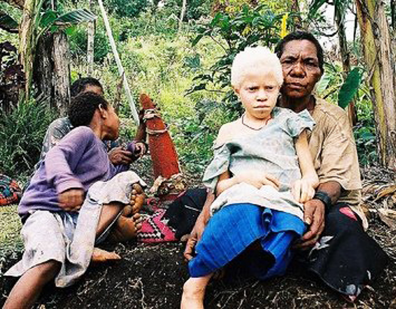 Albinismus