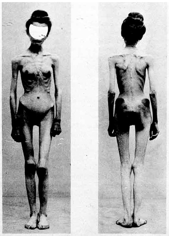 Anorexia nervosa