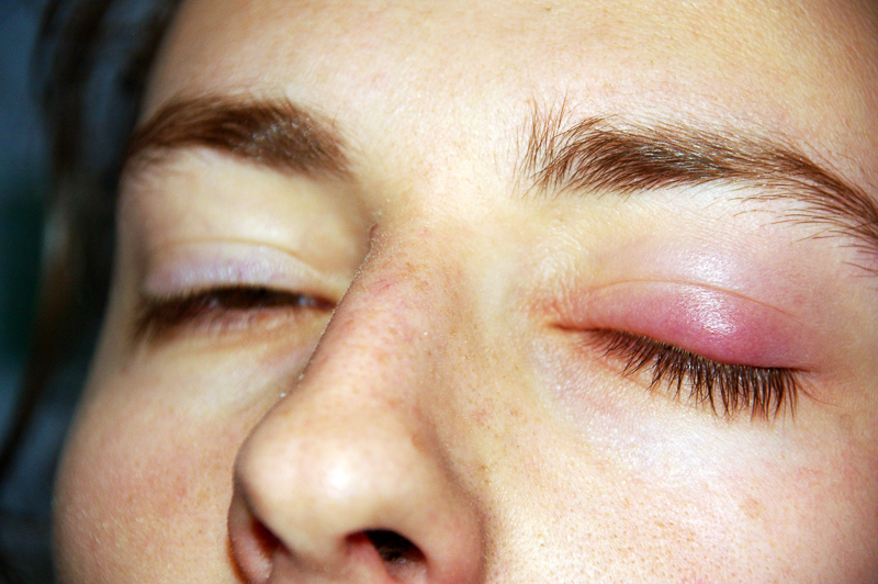 Chalazion Definition And Synonyms Of Chalazion In The German Dictionary