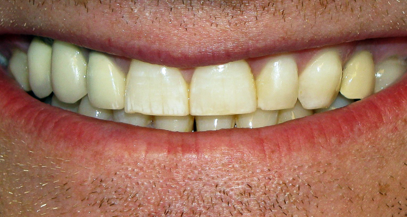 Dentalfluorose