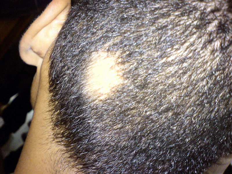 Alopezie