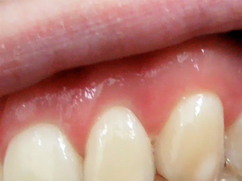 Zahnfleischtasche