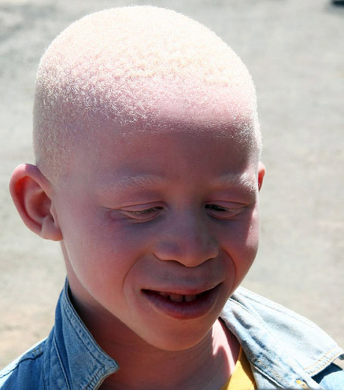 albinistic