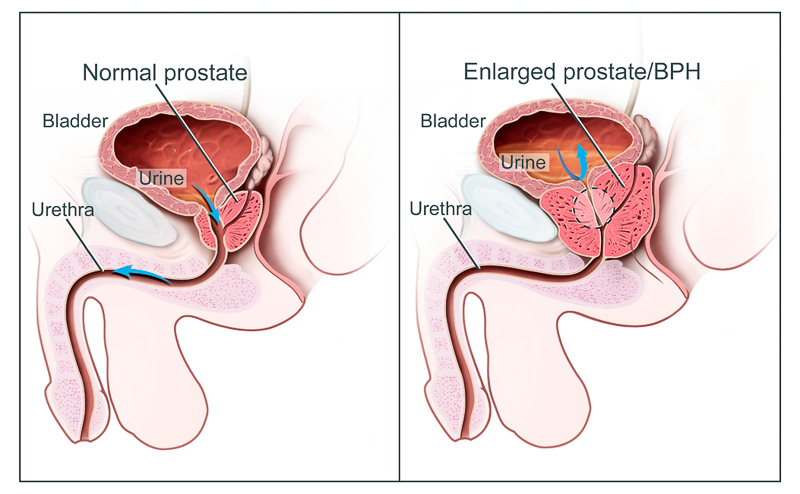 Rhyme prosztatitis prostatitis anus pain