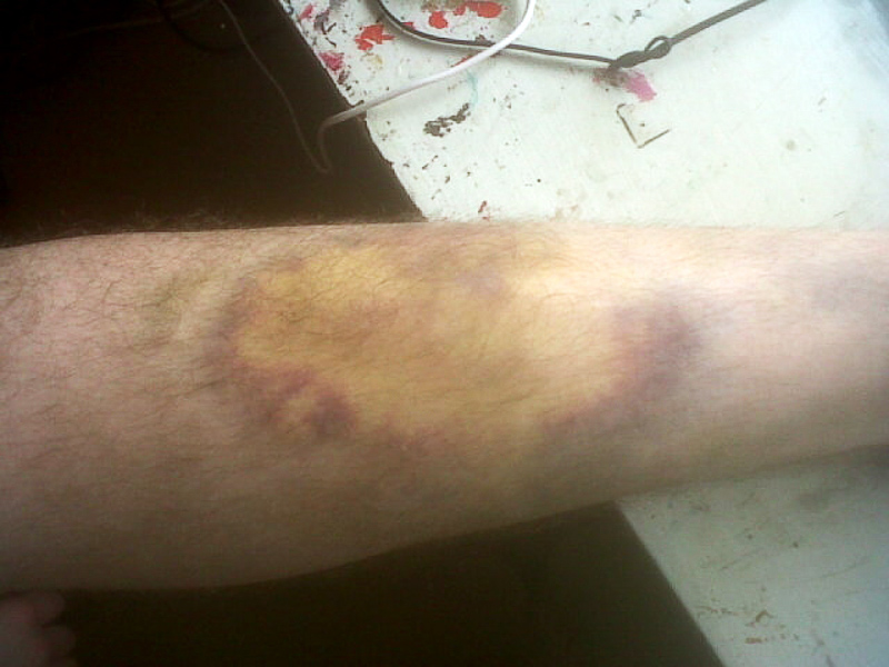 bruised