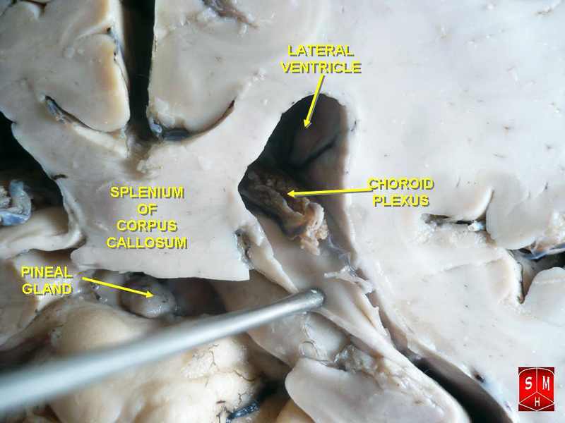 papilloma of choroid plexus meaning