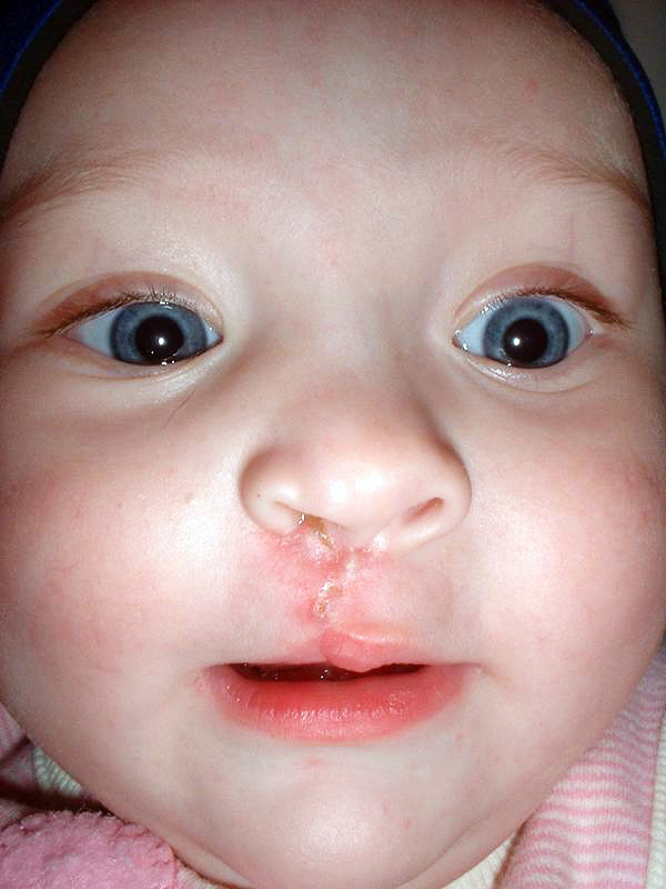 cleft palate
