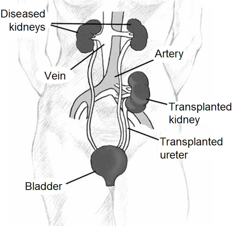 kidney transplant