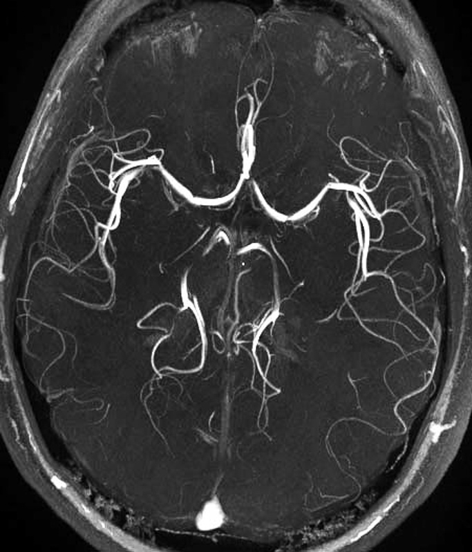 magnetic resonance angiography