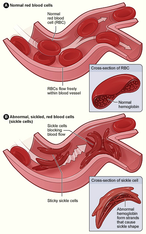 sickle-cell anaemia