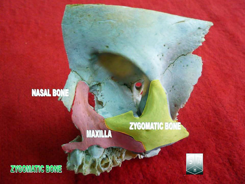malar bone