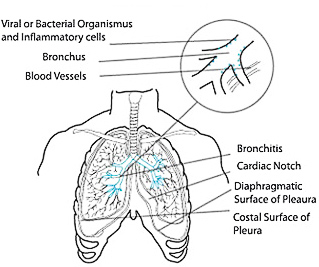 Bronquitis スペイン語辞典でのbronquitisの定義と同義語