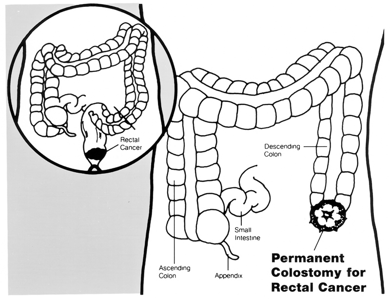 colostomía