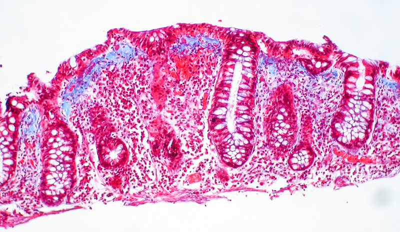 enterocolitis