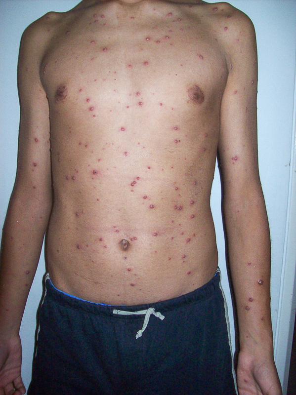 varicoză varicală