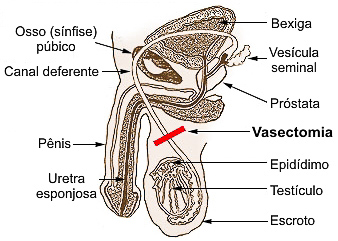 vasectomía