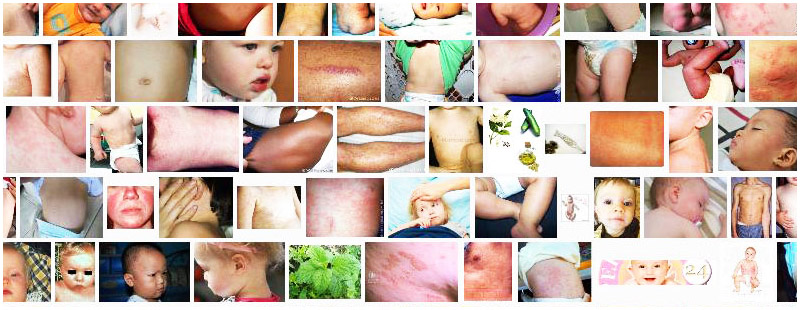 Roseola Definition And Synonyms Of Roseola In The Spanish Dictionary