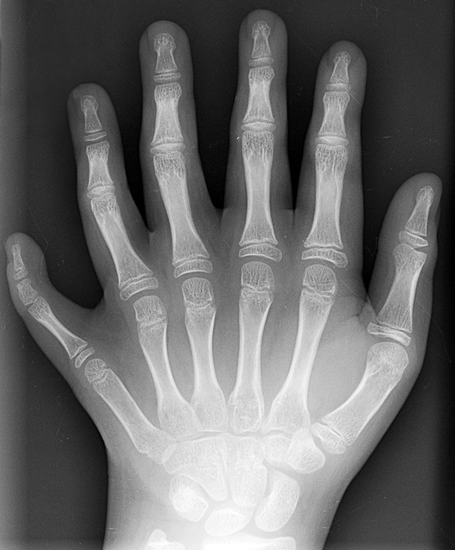 polydactylie
