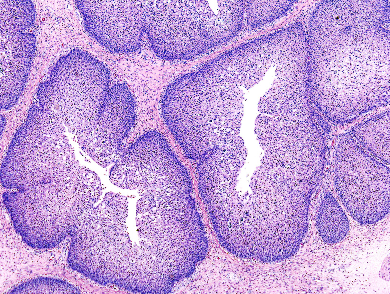 papilloma virus vescicale