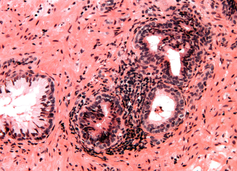 Cancer testicular marcadores tumorales. CA Testicular, Cancer de prostata ubicacion