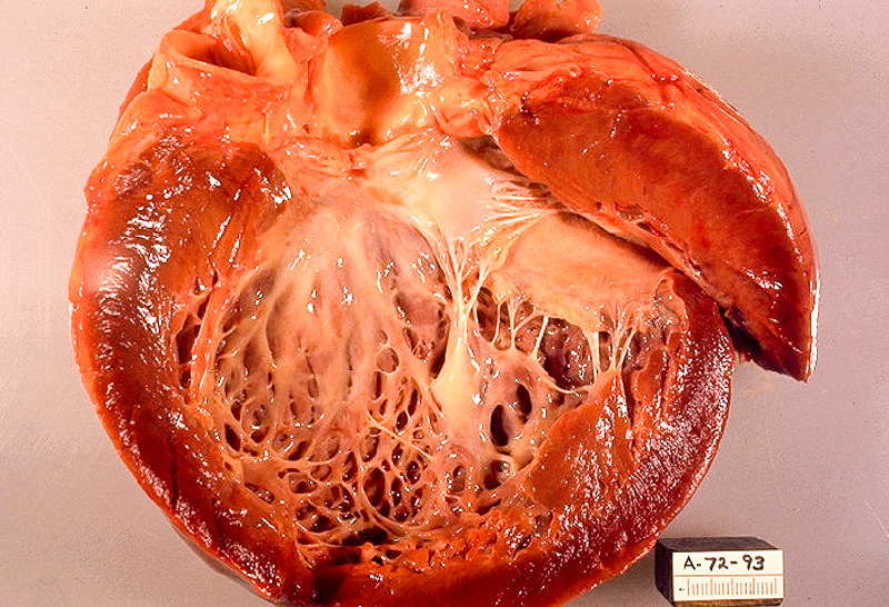 kardiomiopati