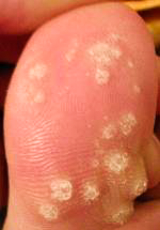 Papiloma kutil. Human papillomavirus or HPV virus del papiloma en garganta sintomas
