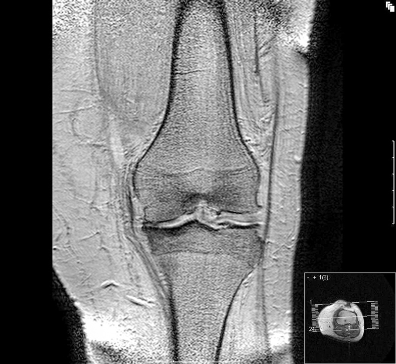 artroza genunchiului la vârsta de 30 de ani de ce durează articulațiile brațului