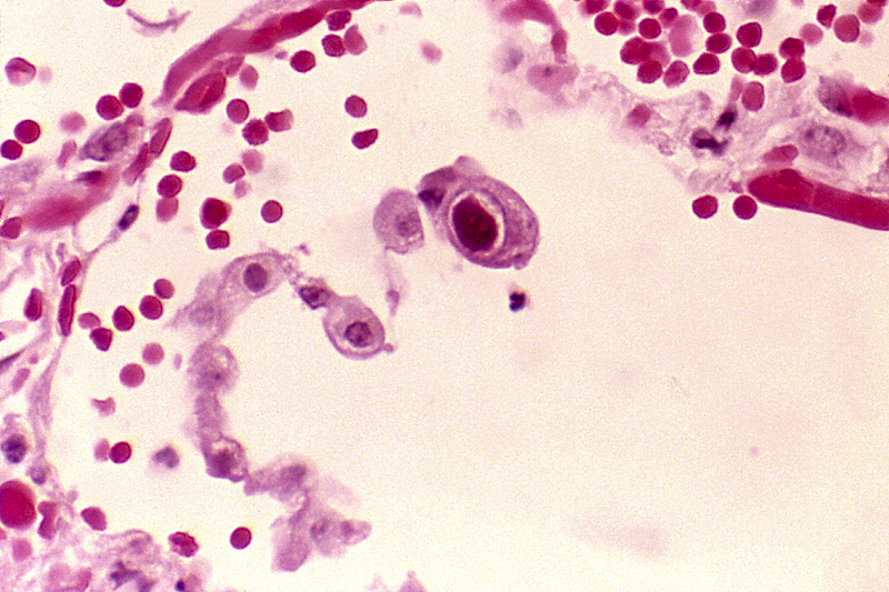 cytomegalia