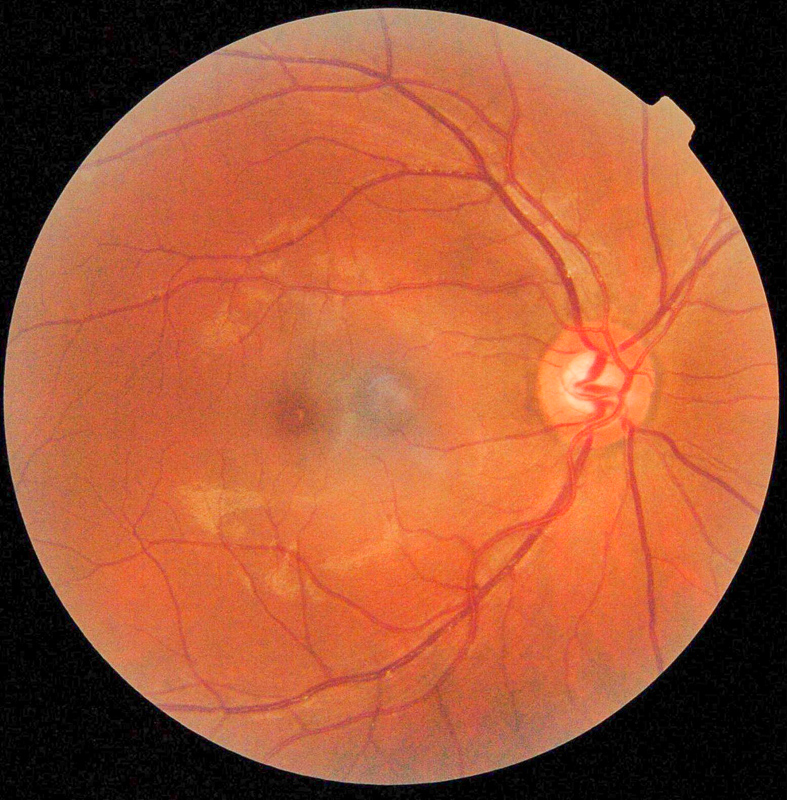 oftalmoskopia