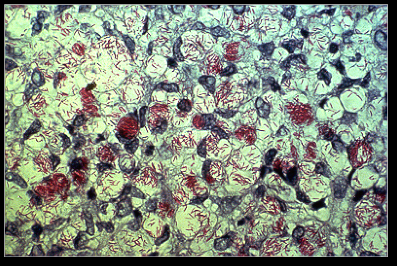 micobactéria
