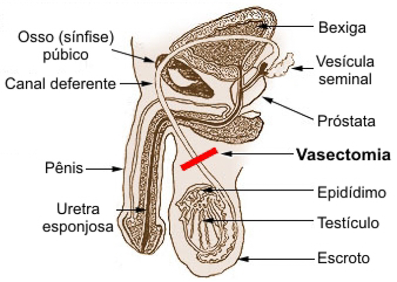 vasectomia