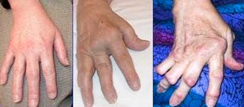 artrita in limba engleza tratament articular artroză la domiciliu
