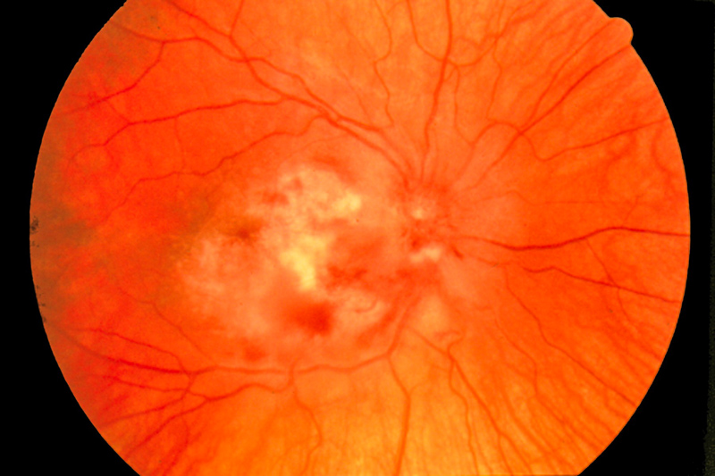 ретинит